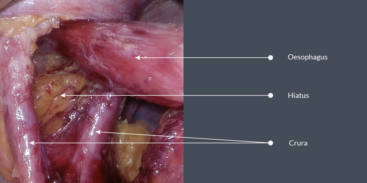 Surgical view of lower oesophagus and crura of diaphragm after dissection in a patient with a large hiatus hernia